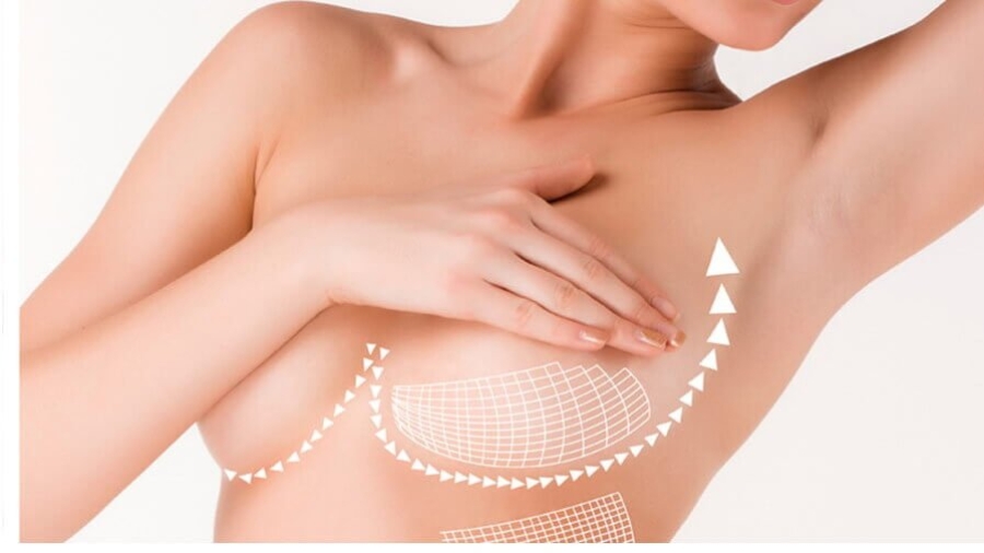Breast Lift and Augmentation